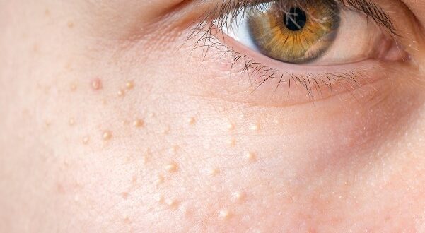 milialar: Understanding the Small, White Bumps on Your Skin